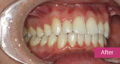 Invisalign Treatment after 9