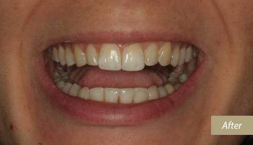 invisalign after 1