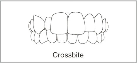 Crossbite - Adult Braces Clinic