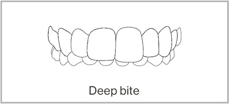 Deepbite - Adult Braces Clinic