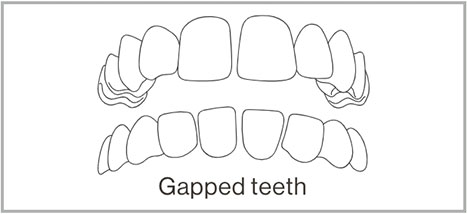 Gapped Teeth