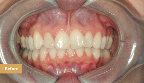 Invisalign and Contouring before 2