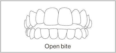 Openbite - Adult Braces Clinic