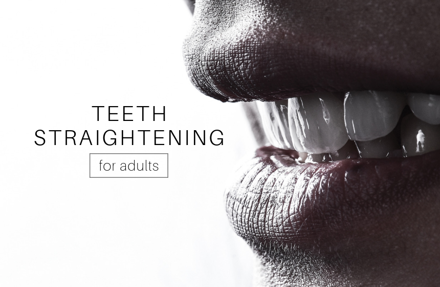 Teeth Straightening for Adults