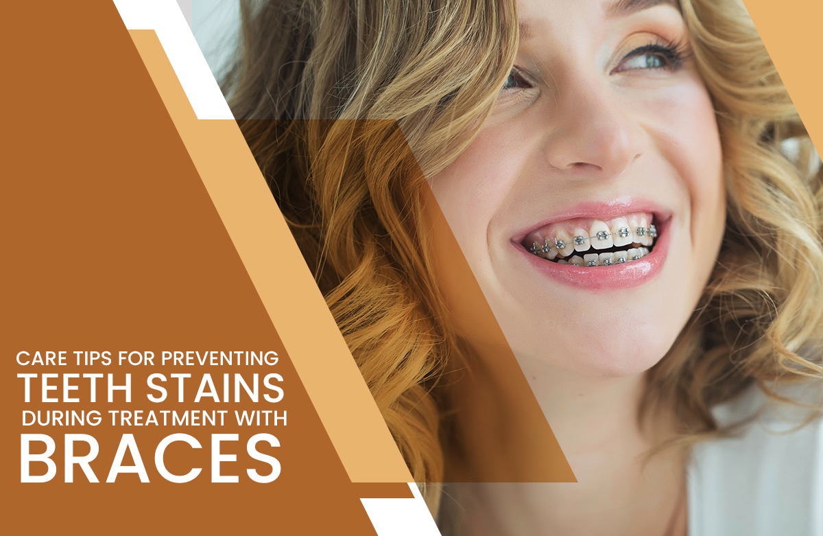 Care Tips For Preventing Teeth Stains During Treatment With Braces